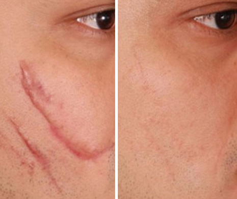 Điều Trị Sẹo Rỗ và Sẹo Lõm Bằng Công Nghệ Plasma